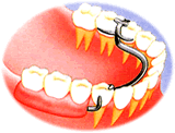 多くの歯を失った場合の従来法